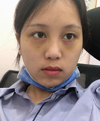 这个眼袋割得真自然,身边的闺蜜都没发现