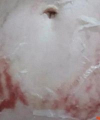 花2000多元去美容机构修复妊娠纹,结果肚皮被整得血淋淋