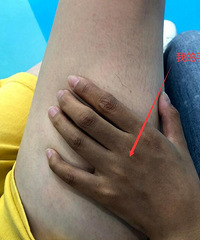 黄黑皮体验了一把高科技,直接给你们晒做完几天后的无P对比图