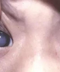孩子在儿童医院确诊为白内障,已经严重到看不清,医生喊尽快手术
