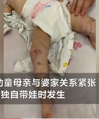 成都幼童疑被母亲虐打,肛门部出血,遍体鳞伤