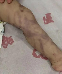 成都1岁婴儿疑遭母亲虐待进ICU