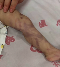 ���ߣ��ɶ�1��Ӥ�����⸸ĸŰ����ICU��������18����ĸ����