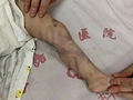 1岁婴儿遭虐待进ICU