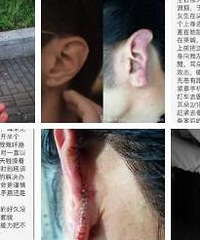 男子阻止街头性侵,被咬掉耳朵!