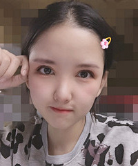 双眼皮真没“性价比”这一说,花了半年时间终于回到我想要的模样