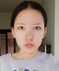 双眼皮真没“性价比”这一说,花了半年时间终于回到我想要的模样