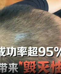 24岁小伙贷款植发却越来越秃
