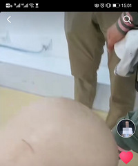 宝宝发烧,妈妈使用了小儿氨酚黄那敏颗粒出现脱发、掉眉毛!