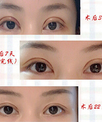 在贵阳做双眼皮手术需要开眼角吗?贵州省二医整形科