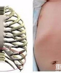 小儿肋骨外翻要紧吗?为什么最后一根肋骨外翻的越来越严重呢?