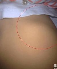 小儿肋骨外翻要紧吗?为什么最后一根肋骨外翻的越来越严重呢?