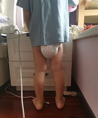 关于小孩足外翻、x腿,我们去了沙区妇幼做了下肢评估科,