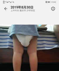 关于小孩足外翻、x腿,我们去了沙区妇幼做了下肢评估科,
