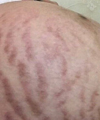 怀孕36周肚子花成了“大西瓜”,后悔没擦防妊娠霜,还有救吗?