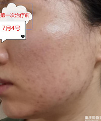 不吹不黑,从初中开始长痘,13年痘龄的我来一个真实祛痘体验