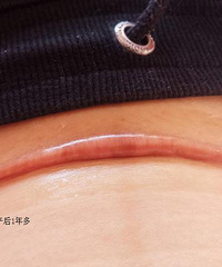 剖腹产后伤口多久恢复?看到大家晒的伤口照,我都不敢剖了