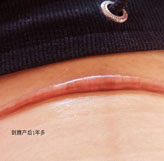 剖腹产一年伤口长这样