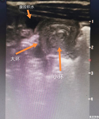 孩子哭闹别大意,肚子摸摸排意外,疼痛拒按要检查,预防肠套叠