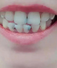 当我看到红斑狼疮患者后,才知道它让人心生恐惧的远不止脸上的疮