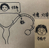 一眼就懂的宫外孕科普
