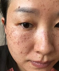 生娃之后长了好多妊娠斑,祛斑产品都不管用,现在才找对了方法