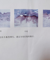 在网上得足底底痣有癌变可能,我去做了切痣手术