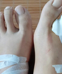 脚底有痣容易癌变?我去做了手术