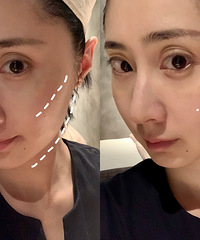抗糖初体验!做完抗糖spa能明显感受到苹果肌的提升