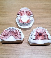 突击儿童口腔医生日常,详细打探当下热门的牙齿矫正,窝沟封闭