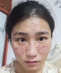 实拍记录我的祛斑恢复过程,2周过后斑没了白点又出来了,心塞