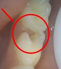 血泪教训,没仔细刷牙,孩子3颗乳牙烂了做根管,还不一定能保住