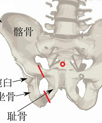我从两米高的地方一脚踩空,然后骨盆断成了木头茬