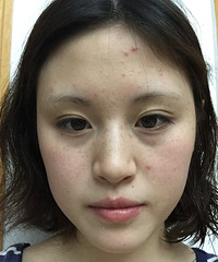 终于去做了激光祛斑,第一天的效果就让我惊艳