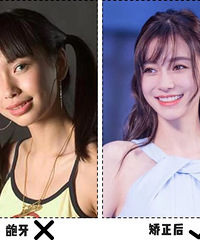 戴牙套=换张脸?尤其是有这3个特点的女生,效果堪比整形