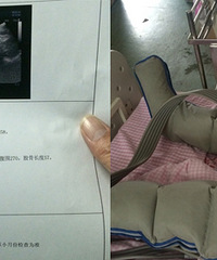 怀双胞胎26周发现宫颈管短,医生说随时可能流产,床都不准下