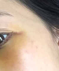 记录人生第一次医美,终于对二十年的眼袋说拜拜