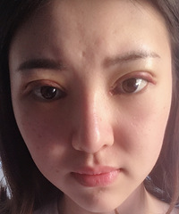 内双是最尴尬的双眼皮,而且还经常肿,不如改变