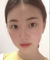 内双眼是最尴尬的双眼皮,闭眼双睁眼单经常肿,不如一割!