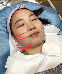 亲身体验!热拉提、海豚拉缇、热玛吉三大抗衰神器哪个更强?