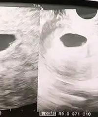 再一个多月就能见面,我却永远失去你,明明产检时都还好好的