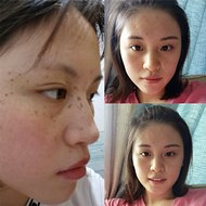 祛斑第一天就效果惊艳