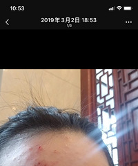 在这里分享我与痘痘抗争的1年多时间
