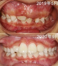 娃儿8岁牙齿矫正1年了,门牙凸出下巴后缩,矫正后对比挺明显