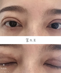 做完双眼皮4个月了,就算显肿有增生也不后悔