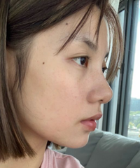 不黑不吹,水光针的效果怎么样?