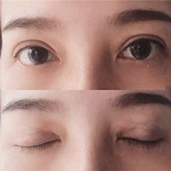 增生也不后悔的双眼皮