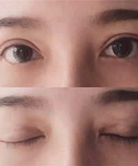 无神的内双肿泡眼,做完“美眼”4个月,就算显肿有增生也不后悔