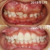 矫正1年后对比好明显