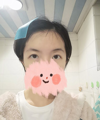 双眼皮的我去做了全切+开眼角【变美龙门阵第1期】